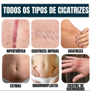 Gel Scar® 100% Advanced Gel - Para todos os Tipos de Cicatrizazes (cesariana, abdominoplastia, cicatrizes antigas, queloides, estrias, queimaduras)